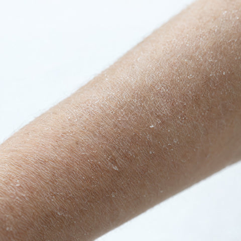 Nærbillede af tør hud på en underarm
